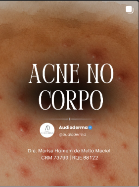 Post Instagram Audioderma