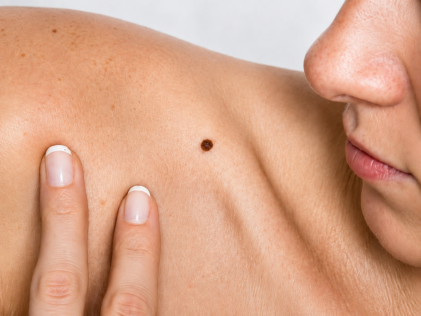 Dermatoscopia para avaliação de pintas e lesões cutâneas